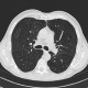 Pneumocystis carinii, pneumocystic pneumonia, follow-up, resolution: CT - Computed tomography